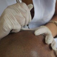Capelli tatuati contro la calvizie