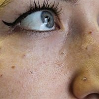 Nuova moda: farsi tatuare le lentiggini